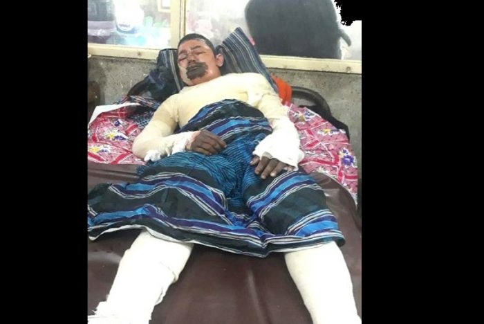 বড়লেখায় অগ্নিদগ্ধ আগর শ্রমিকের মৃত্যু